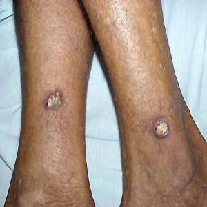 Rogowiak kolczystokomórkowy skóry na nodze