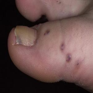 Rogowiec krwawy na palcu u stopy