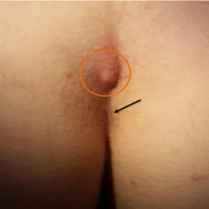 Ropień szpary międzypośladkowej