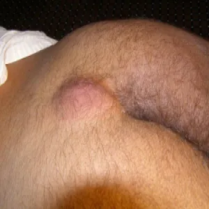 Ropień w okolicy krzyżowo guzicznej