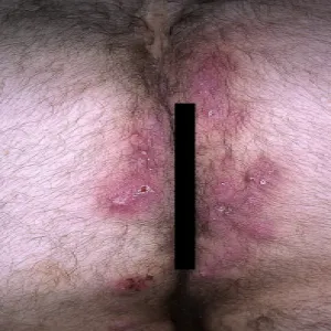 Ropne zapalenie apokrynowych gruczołów potowych pośladków