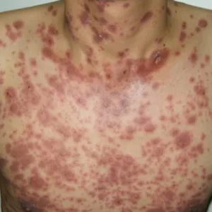 Rozlana wysypka plamisto-grudkowa w przebiegu martwicy toksyczno-rozpływnej naskórka