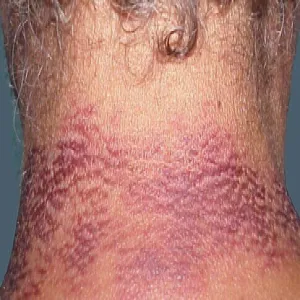 Rumień na szyi pelagra