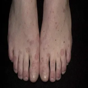 Rumień wielopostaciowy na stopach