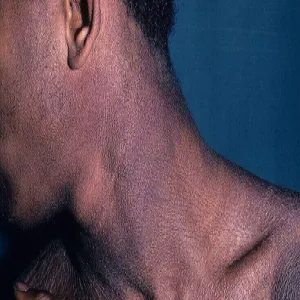 Rybia łuska na szyi