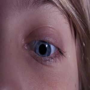 Rzadkie rzęsy łysienie plackowate