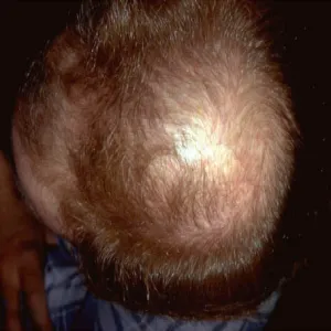 Rzadkie włosy na czubku głowy łysienie androgenowe 