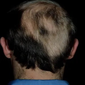 Rzadkie włosy na czubku głowy u mężczyzn