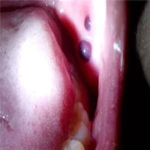 Rzeżączka w jamie ustnej