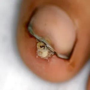 Sarkopsyloza zdjęcie