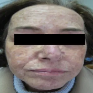 Skóra pergaminowata-barwnikowa  u dorosłych