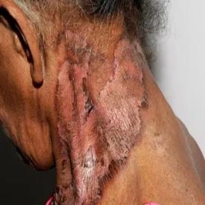 Stany zapalne skóry choroba pelagra