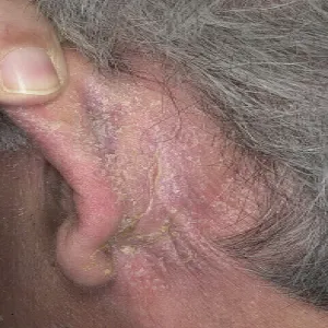 Sucha łuszcząca się skóra za uchem