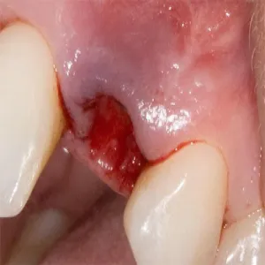 Suchy zębodół surowiczy