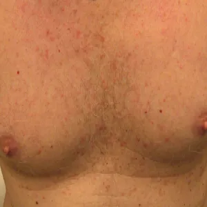 Swędząca wysypka na słońce