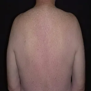 Swędząca wysypka na plecach choroba Grovera