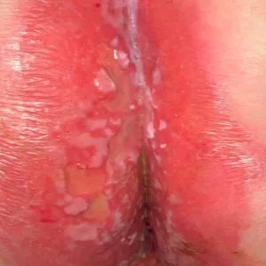 Swędzenie i pieczenie między pośladkami pozasutkowa choroba Pageta 