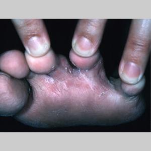 Swędzenie między palcami u nóg stopa sportowca 