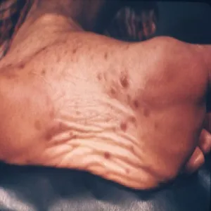 Syfilis wysypka na stopie