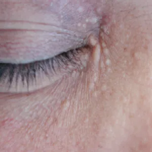 Syringoma