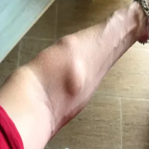 Tłuszcak bolesny choroba Dercuma