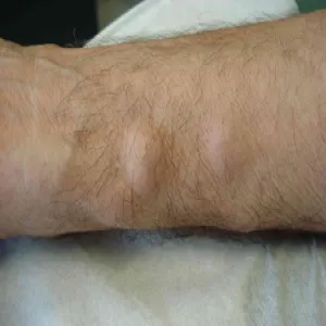 Tłuszczak zlokalizowany na ręce