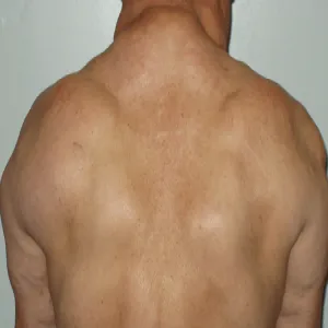 Tłuszczaki na plecach choroba Dercuma