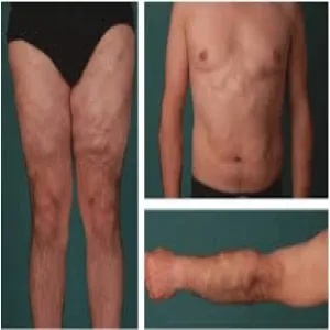 Tłuszczaki podskórne w chorobie Dercuma