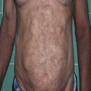 Tłuszczakowatość bolesna