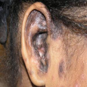 Toczeń rumieniowaty krążkowy w uchu