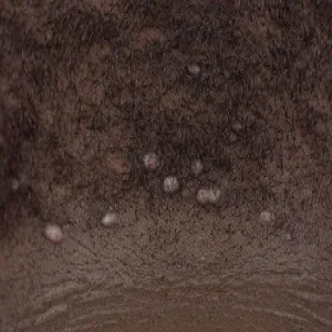 Trądzik keloidowy nuchae zdjęcie