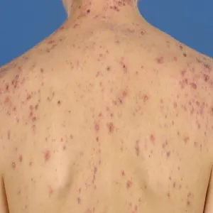 Trądzik piorunujący