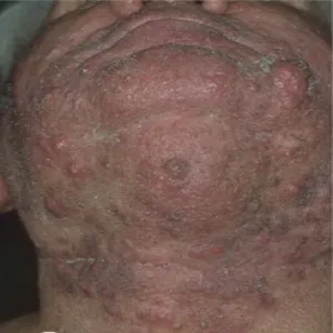 Trądzik skupiony na brodzie