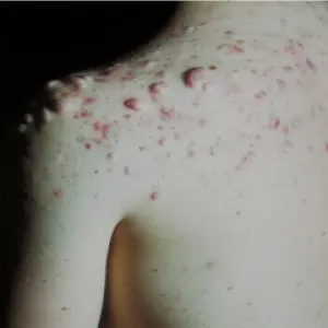 Trądzik skupiony objawy