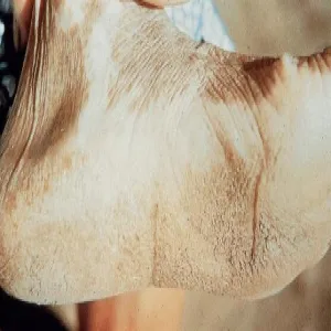 Treponema pallidum objawy choroby frambezja 