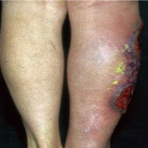 Trudno gojące się rany na nogach choroba piodermia zgorzelinowa