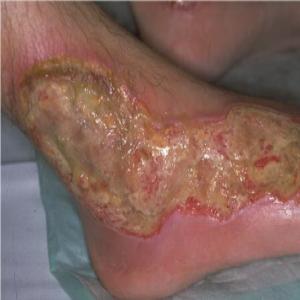 Trudno gojące się rany na stopach piodermia zgorzelinowa
