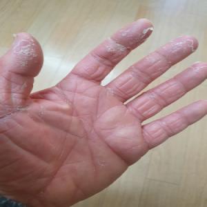 Twarda skóra na palcach dłoni