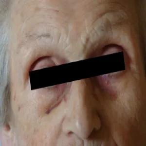 Urazy głowy u osób starszych krwiaki okularowe 