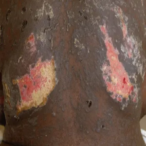 Uszkodzenie naskórka nekroliza 