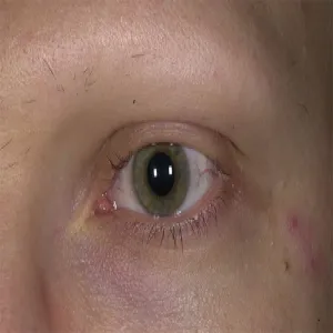 Utrata brwi i rzęs łysienie plackowate