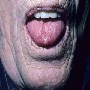 Włókniak jamy ustnej języka zdjęcia
