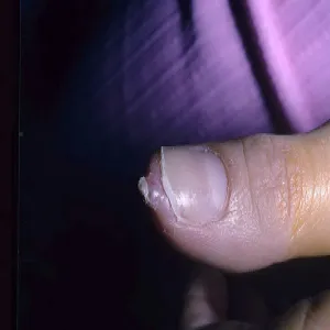 Włókniak twardy na palcu