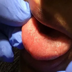 Włókniaki na języku