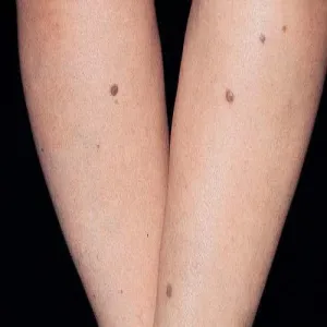 Włókniaki na rękach