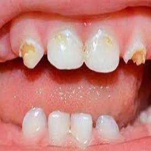 Wczesna próchnica zębów mlecznych