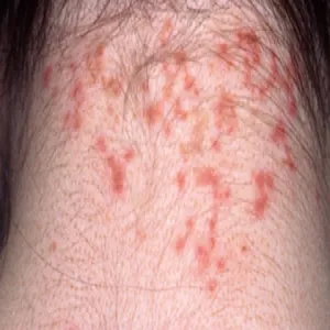 Wesz odzieżowa ugryzienia zdjęcia