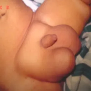 Wodniak jądra u chłopca