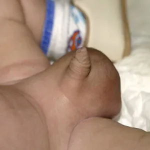 Wodniak jądra u niemowlaka 