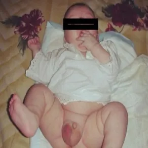 Wodniak jądra u noworodka